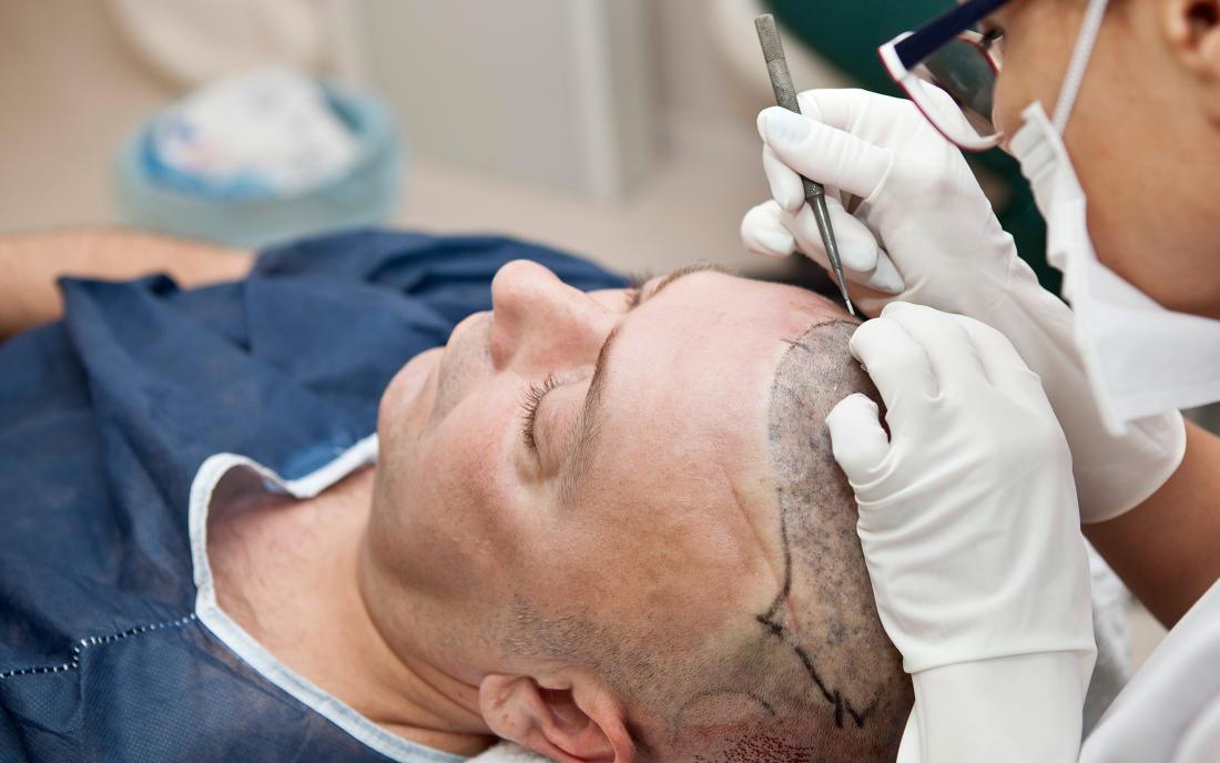 Scalp Micropigmentation