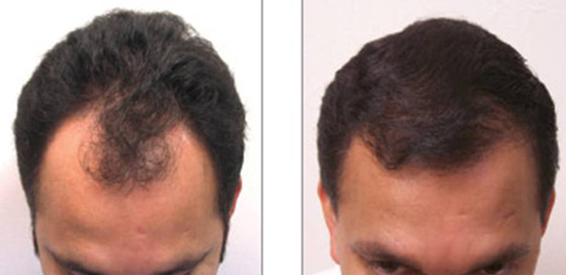 Hair Transplant