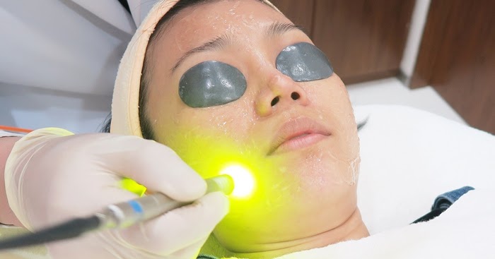 QsNdyag Laser For Pigmentation