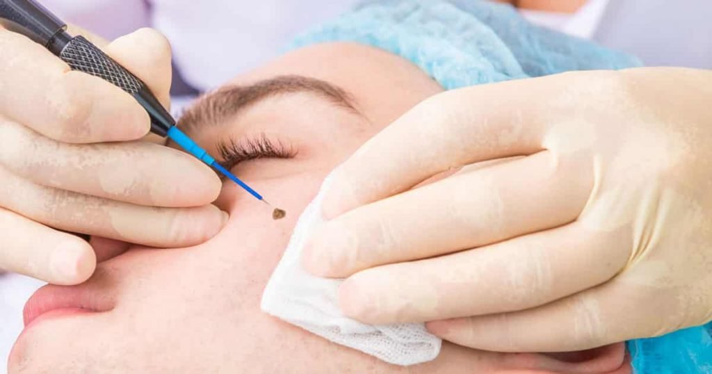 Radio Frequency Cautery